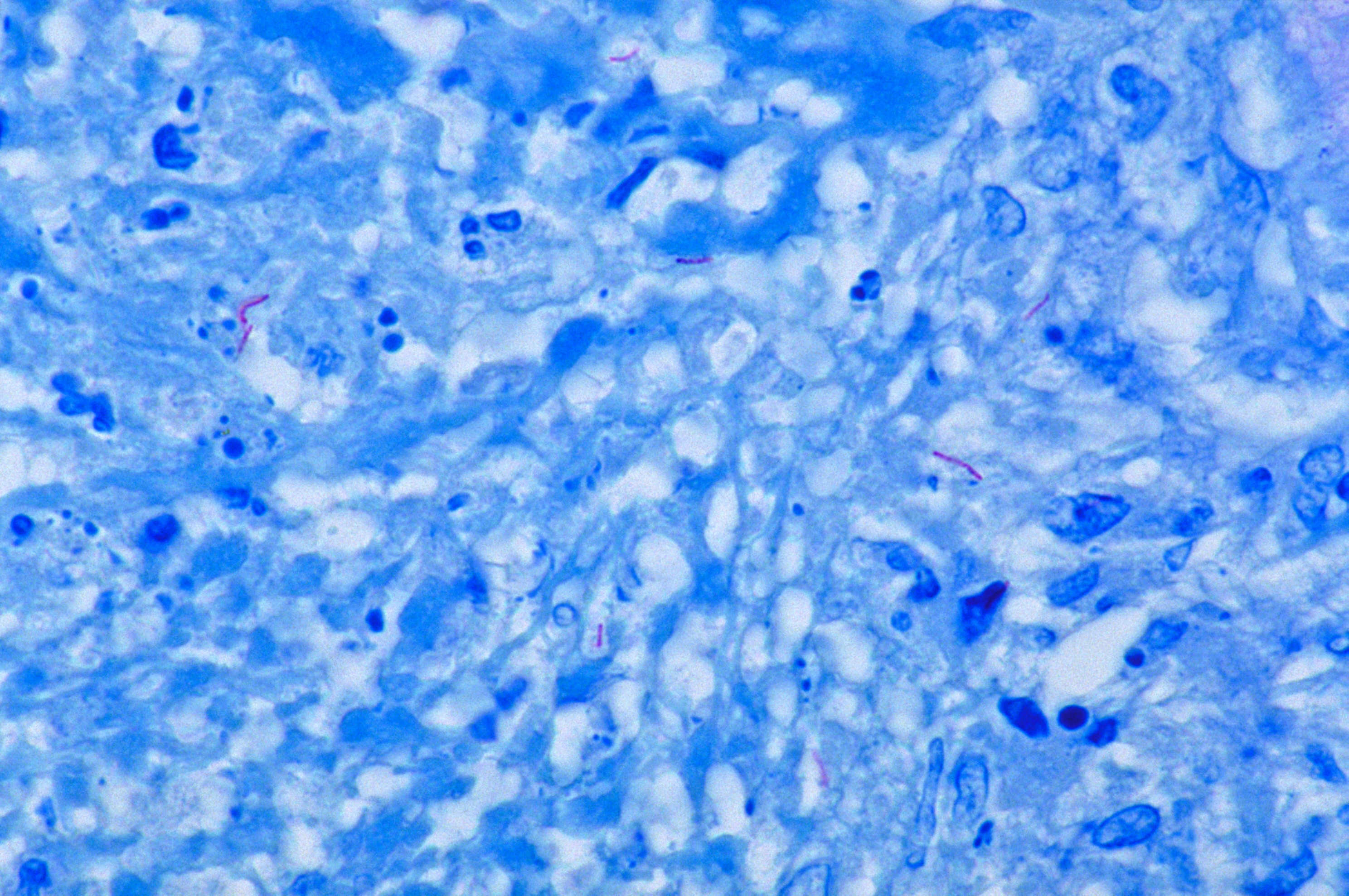 Mycobacterium tuberculosis Ziehl-Neelsen stain