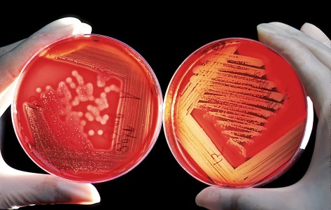 Red blood cells on an agar plate are used to diagnose infection. The plate on the left shows a positive staphylococcus infection. The plate on the right shows a positive streptococcus infection and with the halo effect shows specifically a beta-hemolytic group A.