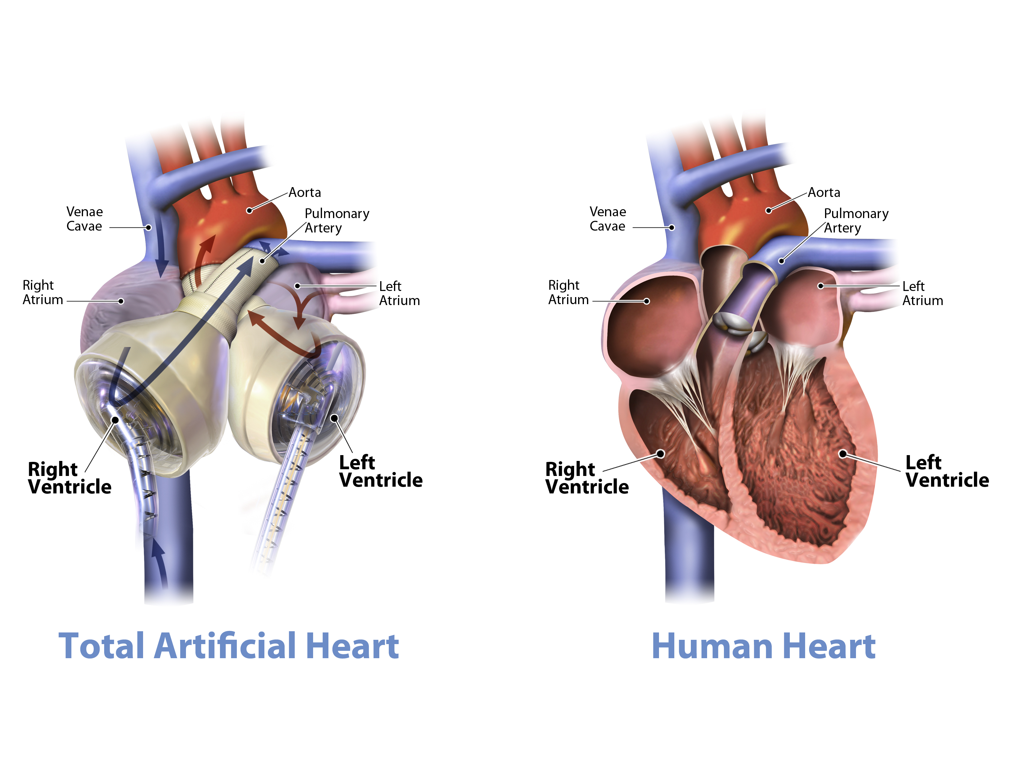 Graphic of the SynCardia temporary Total Artificial Heart beside a human heart