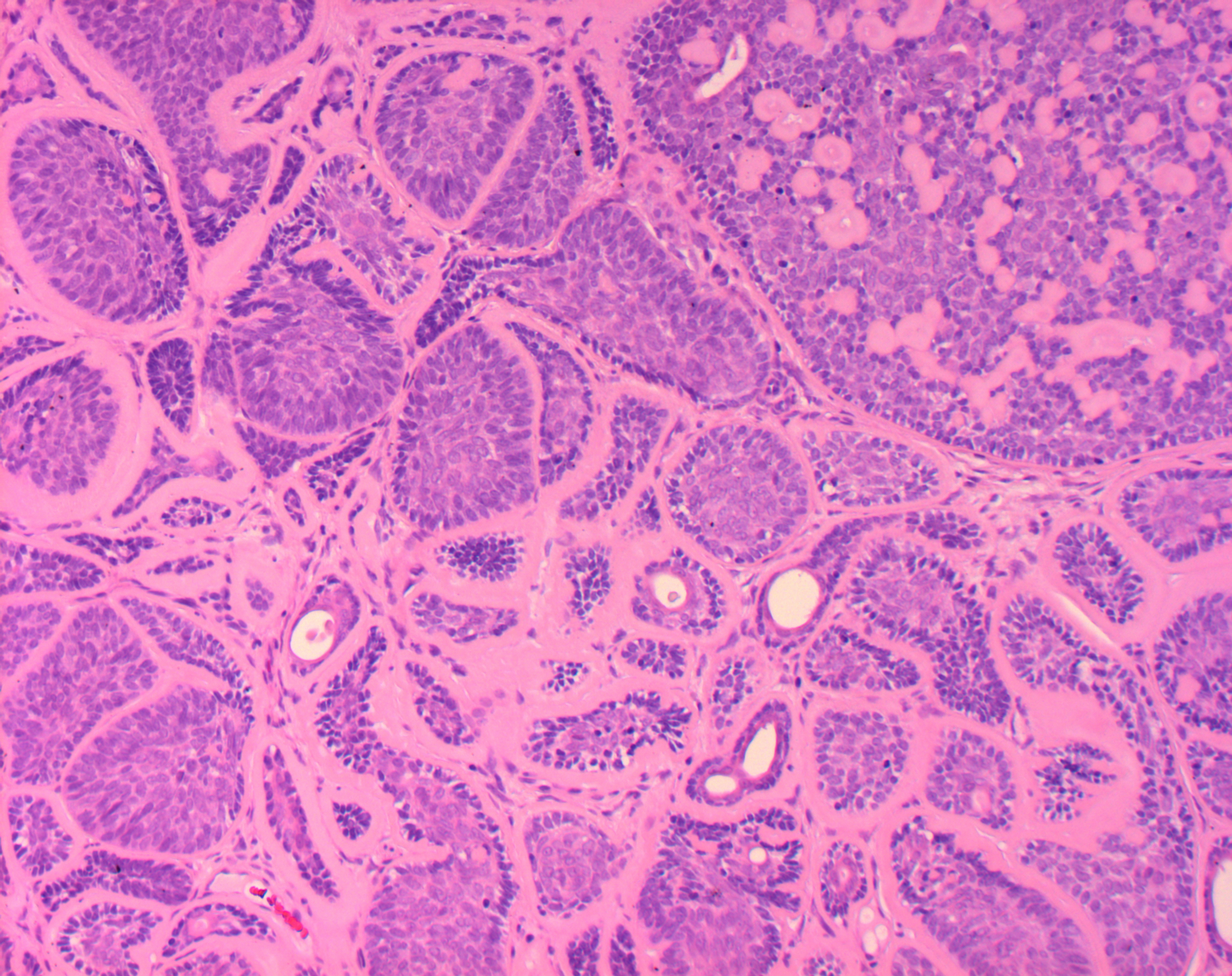Histologie dermales Zylindrom