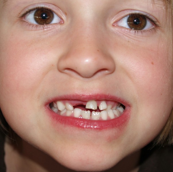 Deciduous teeth by David Shankbone