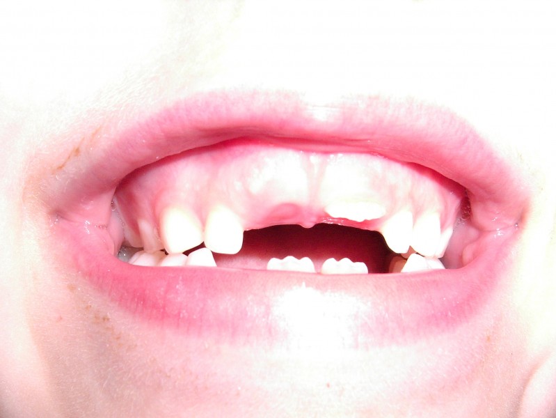 Deciduous teeths